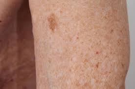 melanoma