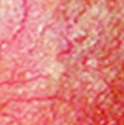 rosecea